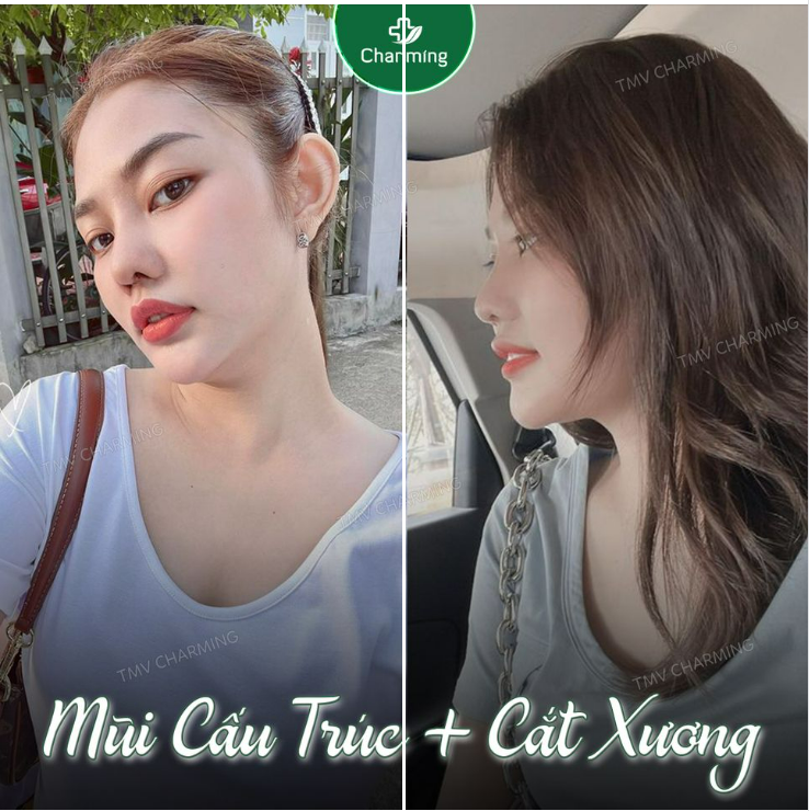 Nâng mũi cấu trúc + cắt xương cần thời gian lâu hơn một chút để hồi phục.