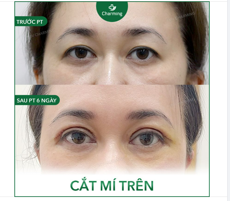 Những đôi mí sau khi cắt được vài ngày đều còn sưng khá nhiều nên không tránh được việc một số bạn thắc mắc tại sao mí sau khi cắt trông mắt lại hơi trợn hơn so với khi chưa cắt.