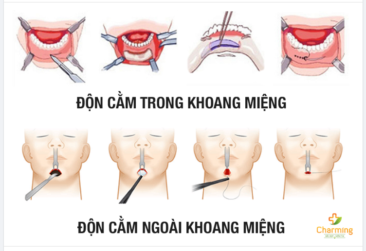 ĐỘN CẰM ĐƯỜNG TRONG HAY ĐƯỜNG NGOÀI THÌ TỐT HƠN?