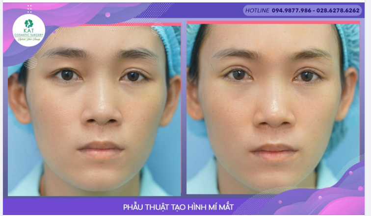 Chỉ với 30 phút phẫu thuật KAT đã giúp bạn tạm biệt đôi mắt không đều, sụp mí và trao lại một đôi mắt hai mí long lanh biết nói.
