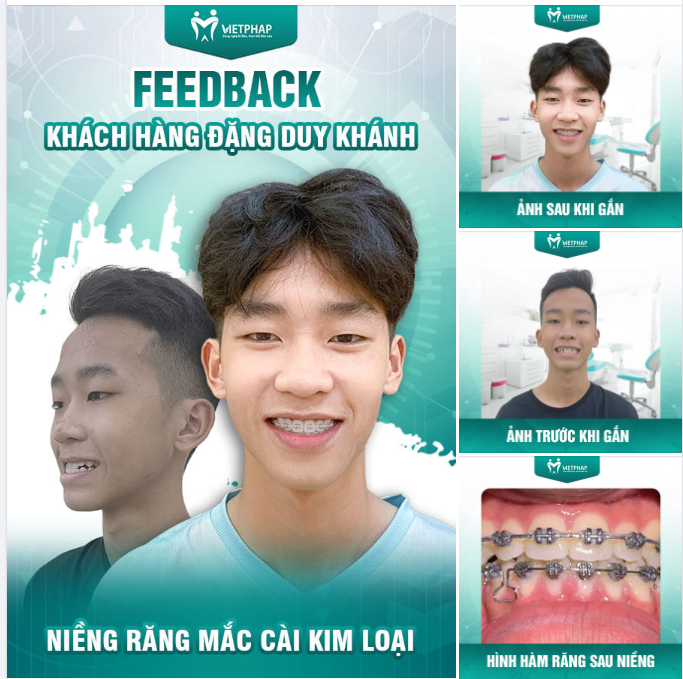 FEEDBACK KHÁCH HÀNG ĐẶNG DUY KHÁNH NIỀNG RĂNG MẮC CÀI KIM LOẠI