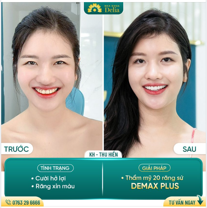 Khách hàng Thu Hiền đến Delia thăm khám