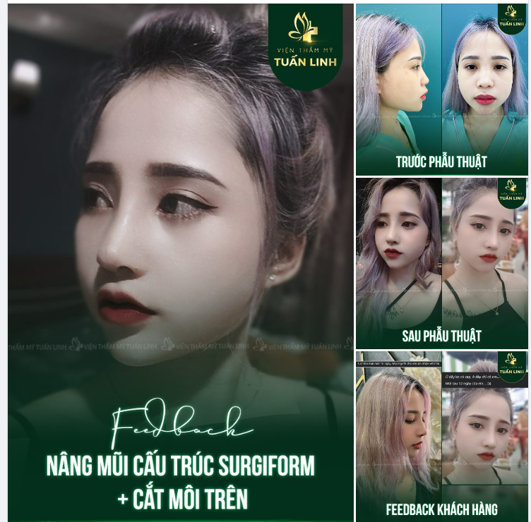 Feedback nâng mũi cấu trúc Surgiform + cắt môi trên đẹp xuất sắc sau 12 ngày