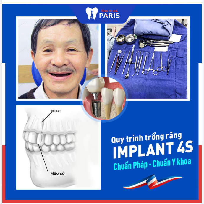 TÌM HIỂU VỀ QUY TRÌNH CẤY GHÉP IMPLANT AN TOÀN - HIỆN ĐẠI NHẤT THẾ GIỚI!