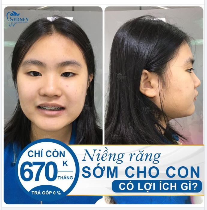 Niềng răng sớm cho con có lợi ích gì?