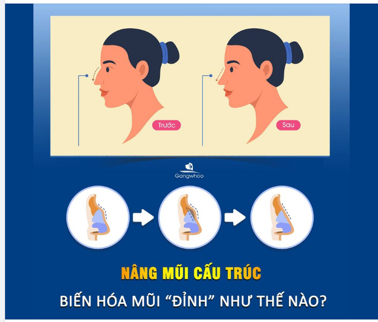 NÂNG MŨI CẤU TRÚC BIẾN HÓA MŨI "ĐỈNH" NHƯ THẾ NÀO?
