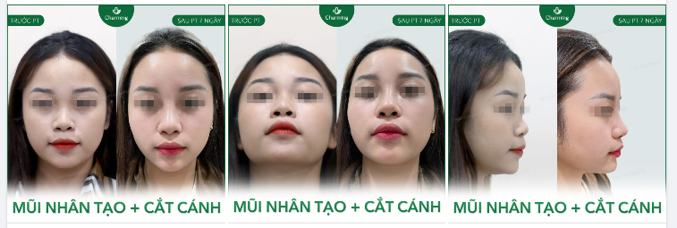 Kết hợp cùng phẫu thuật cắt cánh nữa thì chiếc mũi đã trọn vẹn rồi, không cần gì thêm nhiều nữa.