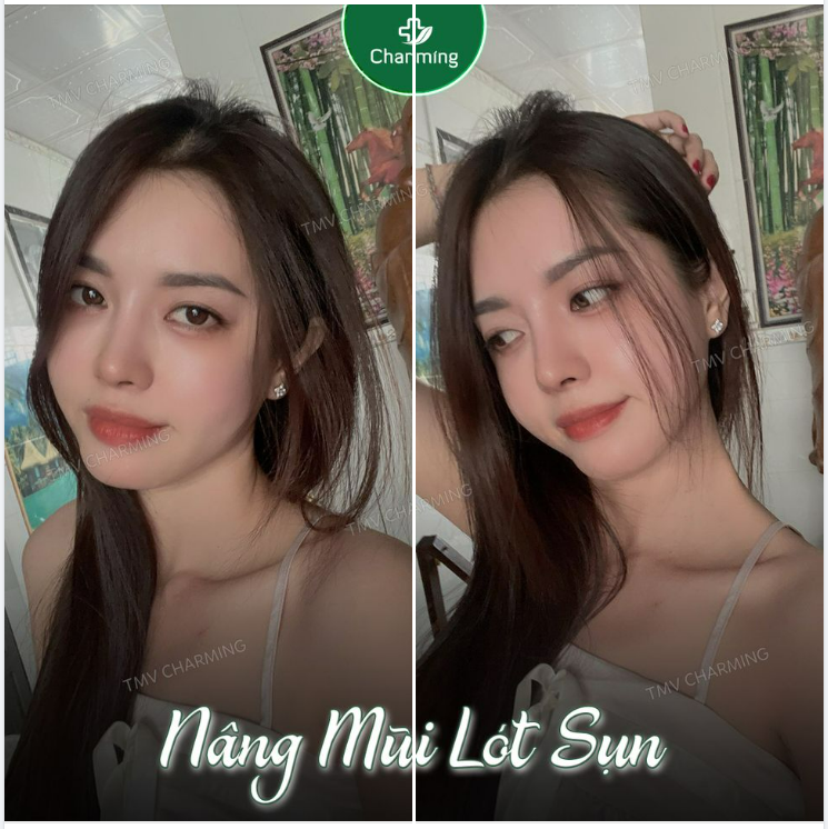 Nhiều bạn cứ gán cho mũi lót sụn cái mác “tự nhiên” rồi mặc định là làm mũi lót sụn thì mũi sẽ không cao, không bay được ​​​​​​​