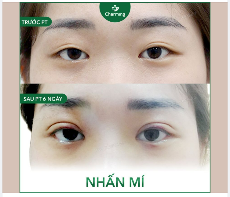 Với những đôi mắt có đường mí mập mờ, không rõ nét, không đủ dài thì yếu tố da chùng, mỡ thừa sẽ được xem xét tiếp theo.
