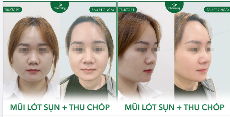 Chiếc mũi thấp vì thiếu độ dài, chóp mũi to khiến gương mặt trông cũng to giờ đã là quá khứ.