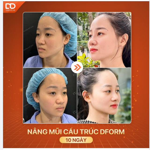 KẾT QUẢ NÂNG MŨI CẤU TRÚC DFORM SAU 10 NGÀY