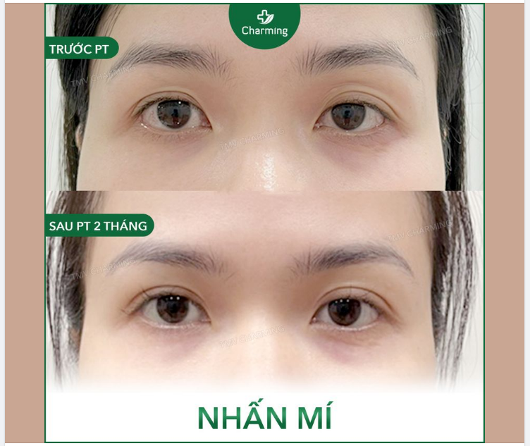 Tạm biệt đôi mắt lờ đờ, thiếu sức sống vì phần mí mắt có nhiều mí lót, giờ đây nàng khách đã có thể tỏa sáng hơn nhờ đôi mắt 2 mí rõ ràng sau khi nhấn mí.