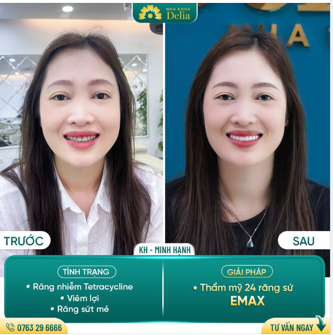 Thay đổi diện mạo gương mặt chỉ sau 48h thẩm mỹ răng sứ tại Delia