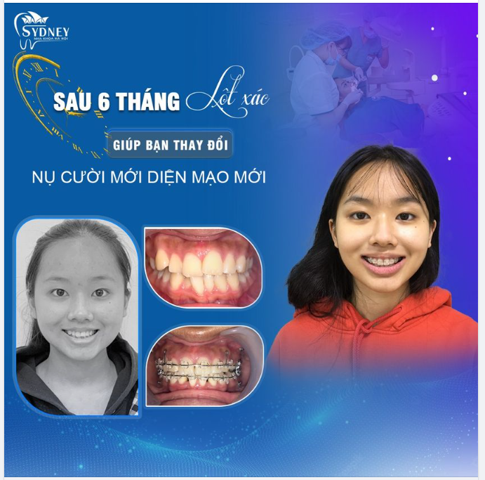 Chi phí thấp, hiệu quả, thẩm mỹ cao – chính là mắc cài pha lê trong suốt!