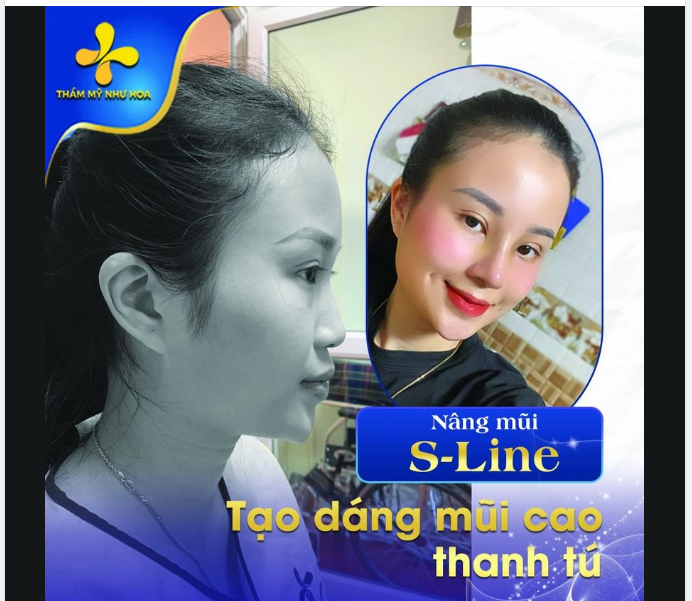 Nâng mũi S-Line sẽ thay đổi đáng kể dáng mũi ban đầu, mang đến cho bạn dáng mũi mới cao hơn, đẹp hơn.