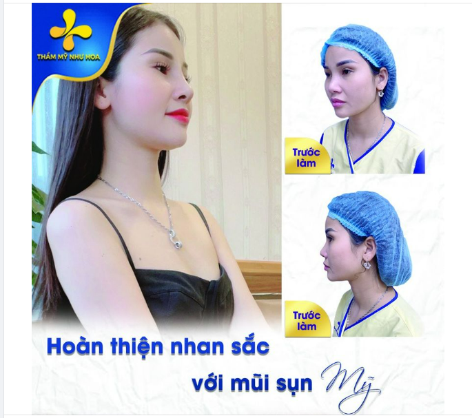 Khách hàng sau khi đến với cơ sở nâng mũi, điều mà họ quan tâm chính là dáng mũi thon gọn, thanh tú, tự nhiên.
