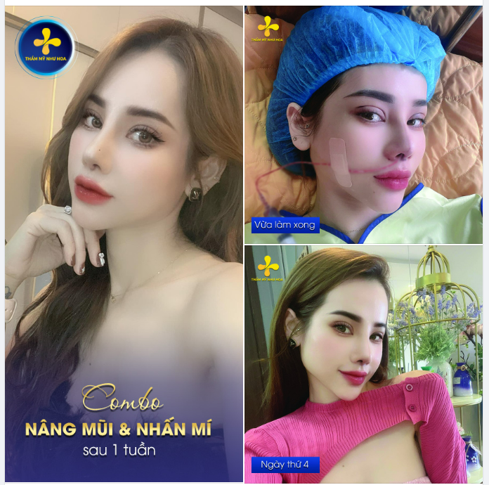 2, 3 CON MỰC ​​​​​​​ MŨI - MÍ XINH CỰC