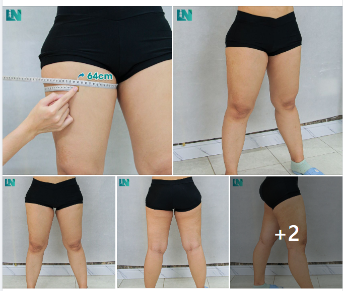 GIẢI PHÁP ĐÔI CHÂN THON NUỘT SAU 60 PHÚT  HÚT MỠ TẠO DÁNG THẨM MỸ ĐÙI CHO CHỊ KH ĐẾN TỪ CÀ MAU, ĐÃ THỰC HIỆN HÚT MỠ BỤNG TẠI EKIP 7 THÁNG TRƯỚC. 