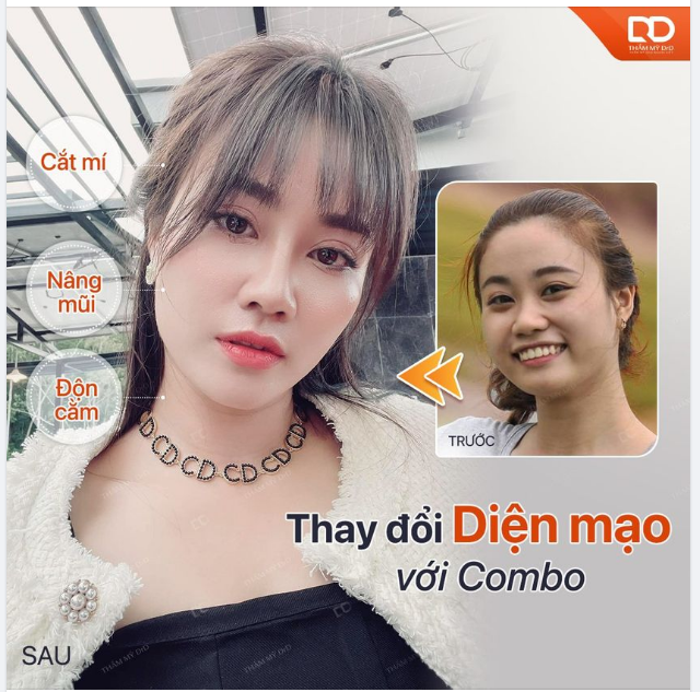 COMBO NÂNG MŨI + CẮT MÍ ĐÃ ĐỈNH RỒI. COMBO NÂNG MŨI + CẮT MÍ + ĐỘN CẰM CÒN ĐỈNH CAO HƠN.