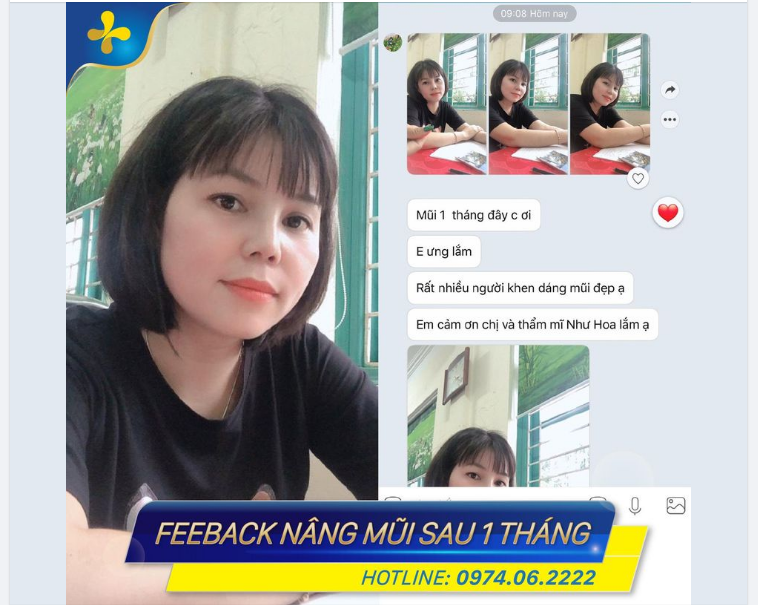 “Mũi 1 tháng đây ạ. Em ưng lắm. Rất nhiều người khen dáng mũi đẹp”