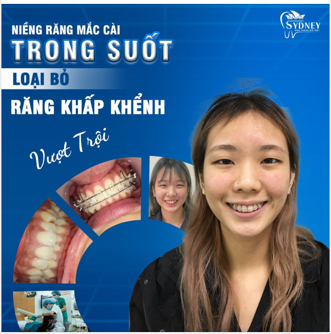Niềng răng mắc cài trong suốt có tốt không?