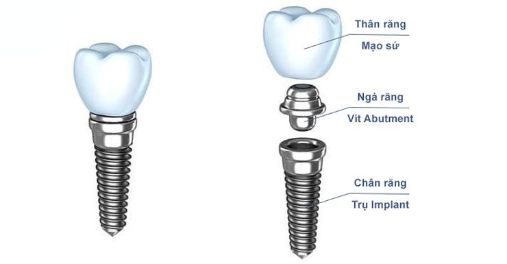 Địa chỉ trồng răng implant uy tín tại Hà Nội