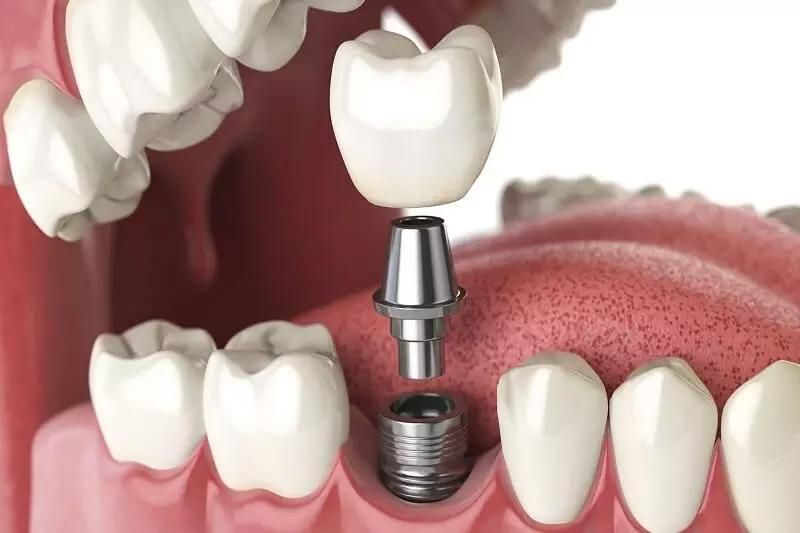https://nhakhoathuyduc.com.vn/wp-content/uploads/2022/08/khi-nao-trong-implant.jpg