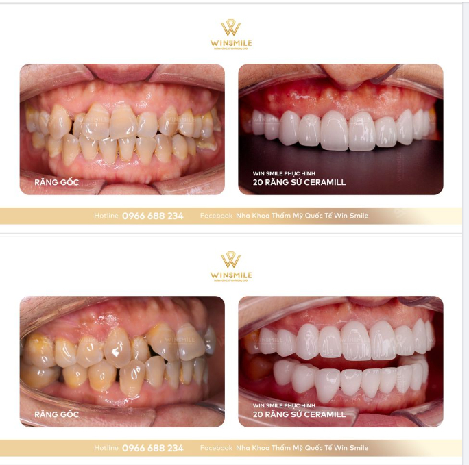 BẬC THẦY PHỤC HÌNH RĂNG CHEN CHÚC & NHIỄM MÀU GỌI TÊN CERAMILL