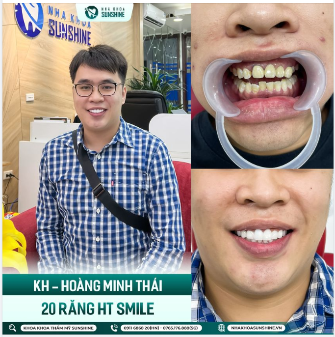 ​​​​​​​Bạn đã từng làm răng sứ thẩm mỹ nhưng gặp nhiều biến chứng bởi tay nghề bác sĩ YẾU, răng sứ kém chất lượng.