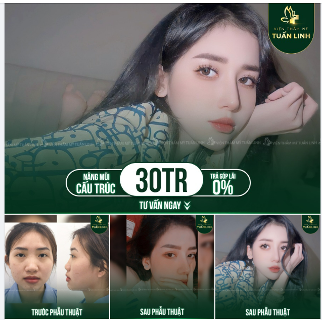 Bạn muốn nâng mũi Bạn muốn làm đẹp Nhưng còn đang băn khoăn về tài chính... Đừng lo, đã có gói trả góp hỗ trợ 0% lãi suất tại Tuấn Linh.