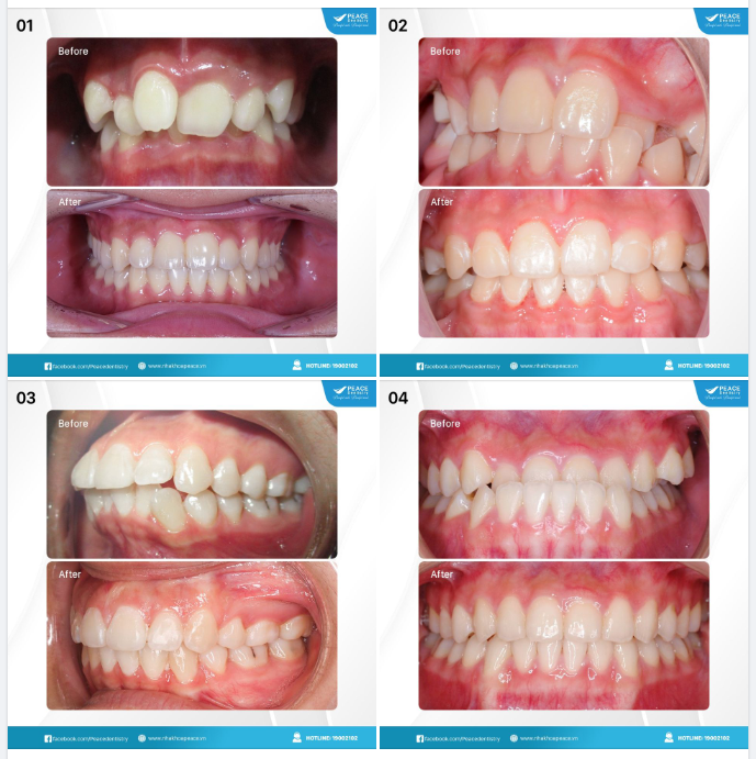 Bạn xem như đã đạt được 90% cho một ca  niềng răng thành công mỹ mãn, 10% còn lại là sự nỗ lực của chính bạn.