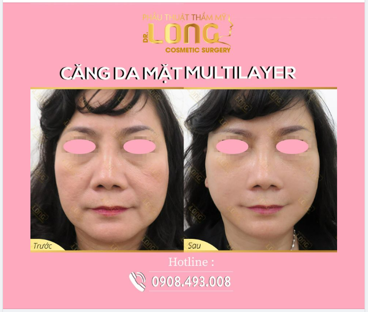 Bí quyết da căng đầy bóng mịn chỉ sau 1 lần duy nhất. Xóa bỏ khuyết điểm trên gương mặt như