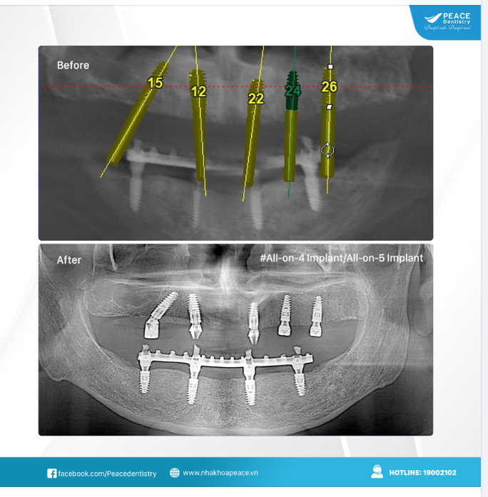 Ca lâm sàng  all on 4 implant cho hàm dưới và  all on 5 implant cho hàm trên giúp Chú khách hàng lớn tuổi ăn nhai khỏe khoắn và trông trẻ hẵn ra.