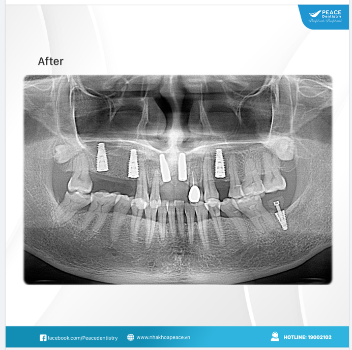 Ca lâm sàng cấy ghép 6 đơn vị implant cho khách hàng mất nhiều răng giúp khôi phục trọn vẹn chức năng ăn nhai, thẩm mỹ nụ cười và ngăn ngừa tiêu xương.
