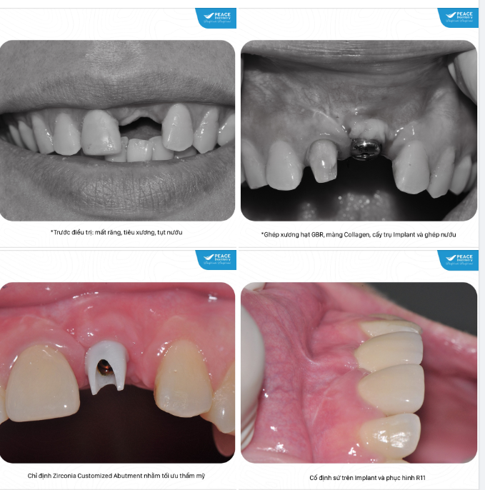 Ca lâm sàng - cấy ghép Implant,  ghép xương và  ghép nướu cho trường hợp mất răng cửa nhiều năm