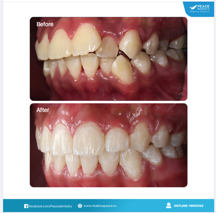 Ca lâm sàng niềng răng cho trường hợp  khớp cắn hạng I, nhô răng 2 hàm, chen chúc; Mắc cài kim loại (buộc thun); Tháo mắc cài sau 22 tháng.