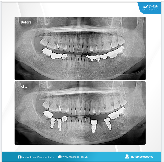 Ca lâm sàng thay thế cầu răng sứ cũ bằng cấy ghép implant