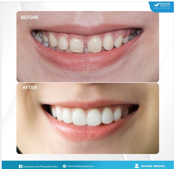 Cải thiện thẩm mỹ nụ cười bằng  mặt dán sứ Veneer