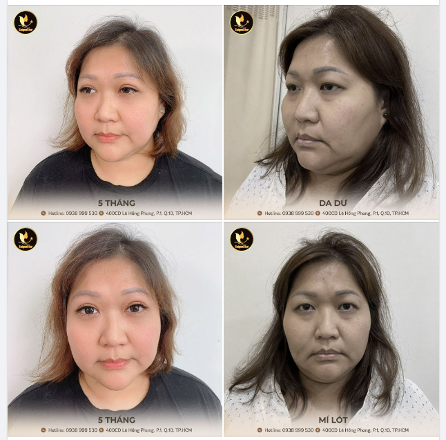 Cắt mí tại Dr. Hoạt là chân ái!