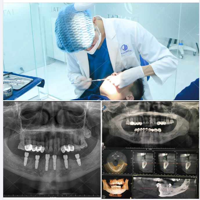 CẤY GHÉP IMPLANT GIẢI PHÁP TỐI ƯU GIÚP LẤY LẠI PHONG ĐỘ VÀ KHẢ NĂNG ĂN NHAI HOÀN HẢO