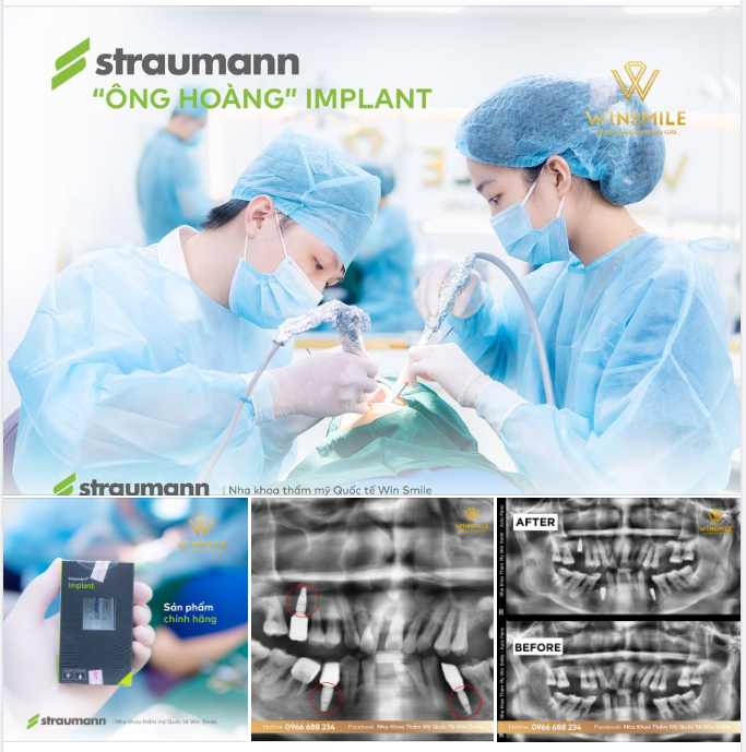 CẤY GHÉP TRỤ IMPLANT STRAUMANN CAO CẤP - ĐỘ BỀN THÁCH THỨC THỜI GIAN