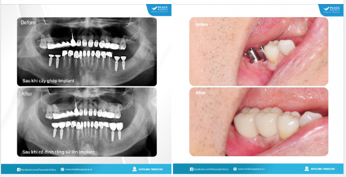Chào bác sĩ,  cấy ghép trụ Implant sau bao lâu mới có thể cố định răng sứ lên Implant?