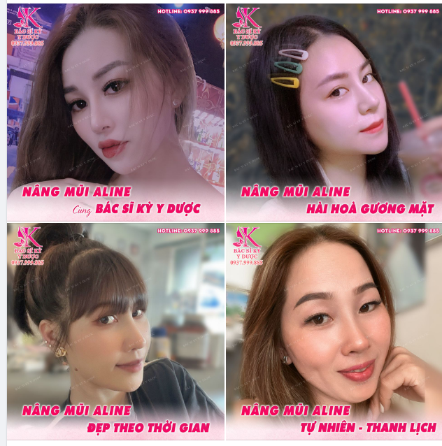 Chỉ với 12 Triệu mà đẹp quá bác sĩ ơi! Nâng mũi ALINE - Độc quyền Bác sĩ Kỳ Y Dược