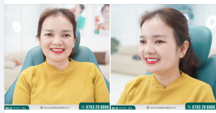 Chiêm ngưỡng nụ cười tự tin của chị Mỹ Vân sau thẩm mỹ răng sứ tại Delia.