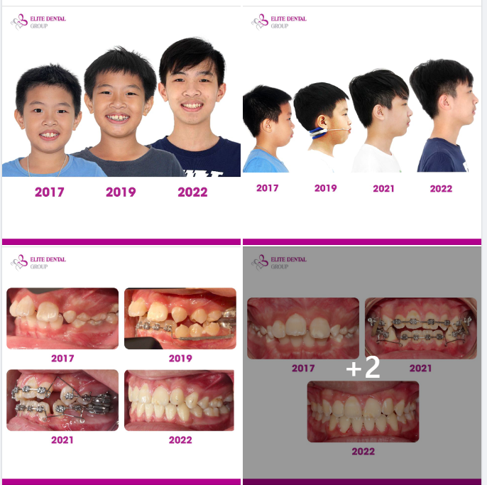 Chỉnh hô từ 9 tuổi, thay đổi hoàn toàn tình trạng hô răng, hô xương