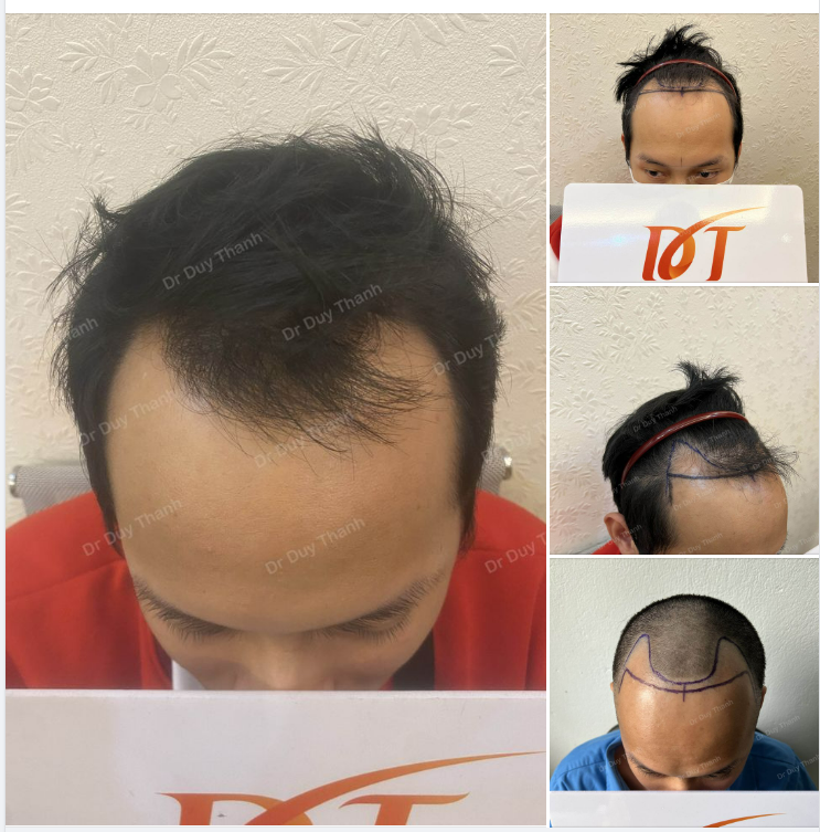 CHUẨN BỊ CẤY 1500 NANG TÓC, BOY HÀ TĨNH 27 TUỔI
