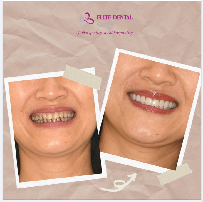 Cười tự tin, rạng rỡ nhờ mặt dán sứ veneer