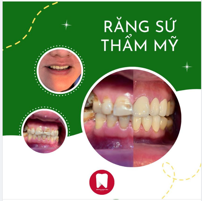 DÁN RĂNG SỨ CHO ANH VIỆT KIỀU PHÁP VÀ KẾT QUẢ TUYỆT VỜI