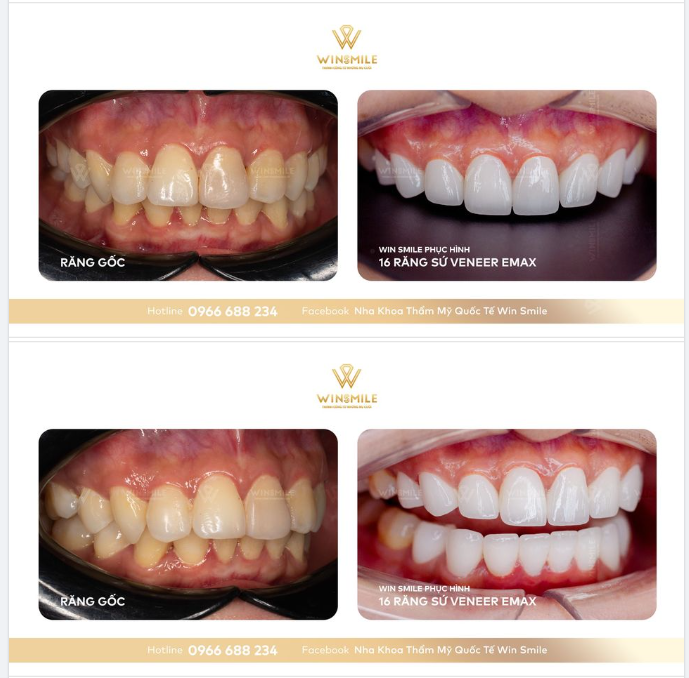 DÁN SỨ VENEER TẠM BIỆT RĂNG TO DÀY Ố VÀNG KHÔNG CẦN MÀI NHIỀU