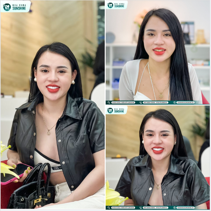 Đánh bay nỗi lo muốn làm răng sứ nhưng sợ răng thật bị xâm lấn quá nhiều 